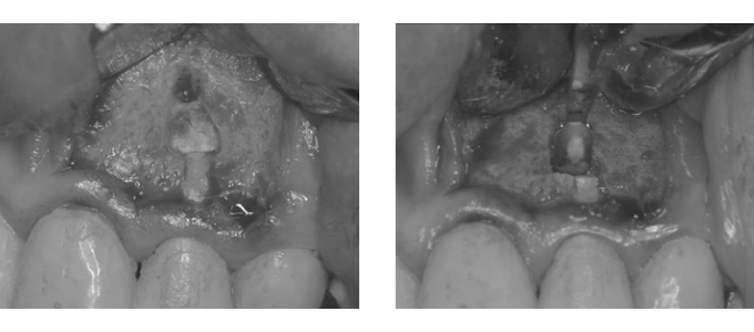 歯根端切除術の症例