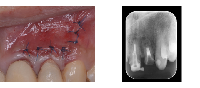 歯根端切除術の症例