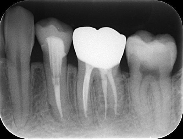 30代女性　左下奥歯を根管治療とセラミックで治療した例