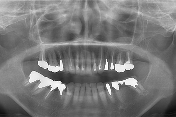 50代女性　被せ物の下にできた虫歯をセラミックとインプラントで全体的に治療した例