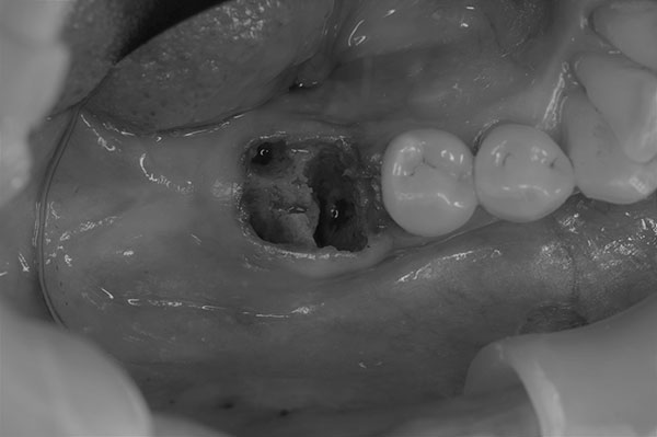 60代女性　痛くて噛めないボロボロの奥歯を抜歯して短期間でインプラント治療した例