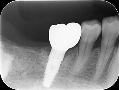 60代女性　痛くて噛めないボロボロの奥歯を抜歯して短期間でインプラント治療した例
