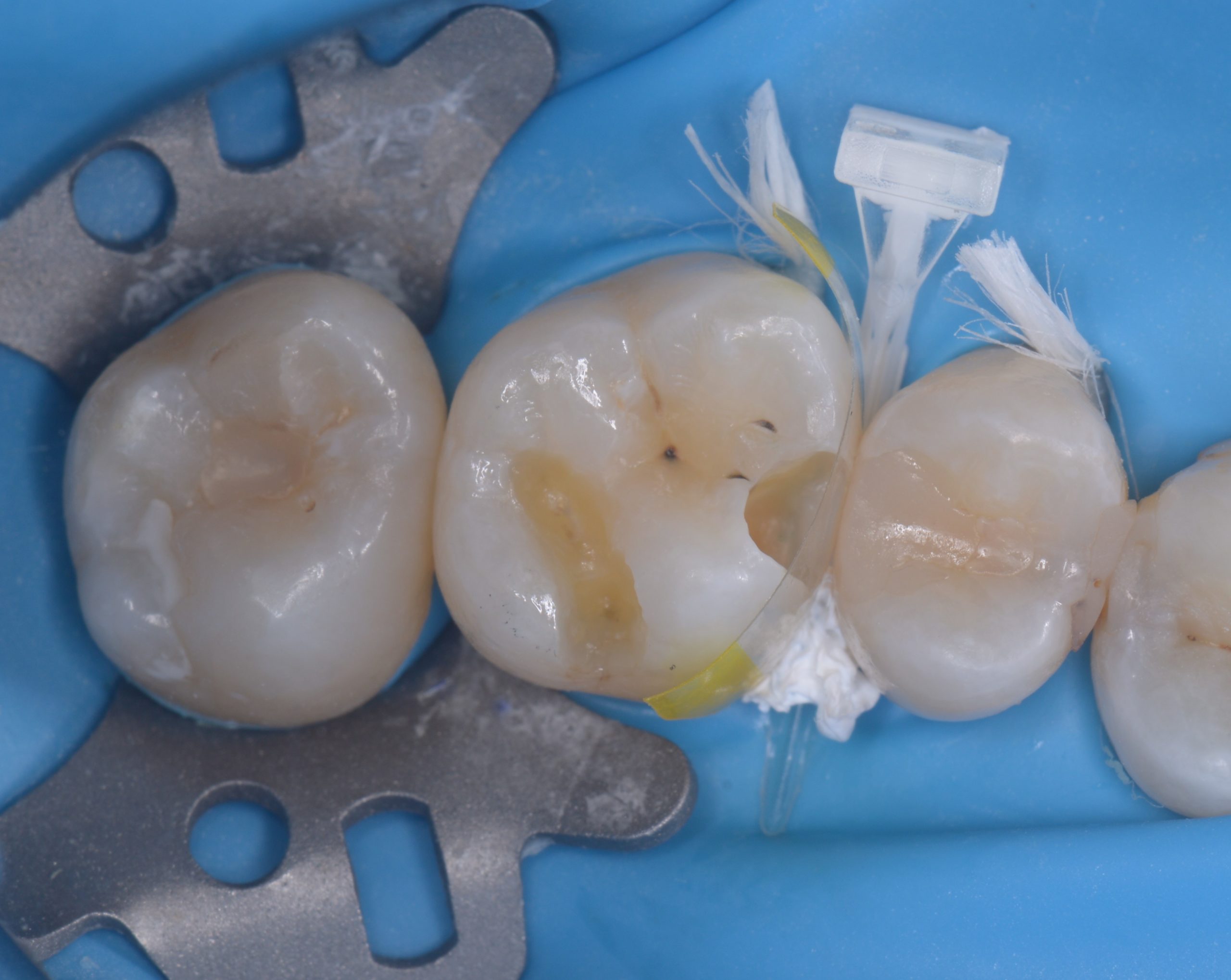 ダイレクトボンディングにより歯の間の虫歯を修復したケース