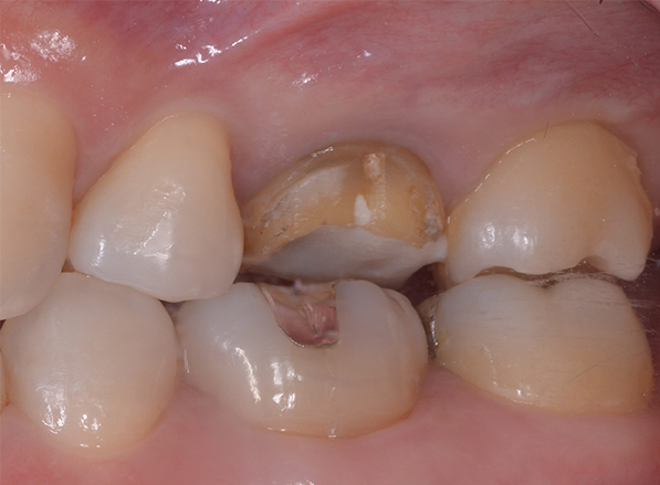 歯が原因の上顎洞炎を精密根管治療で治療したケース
