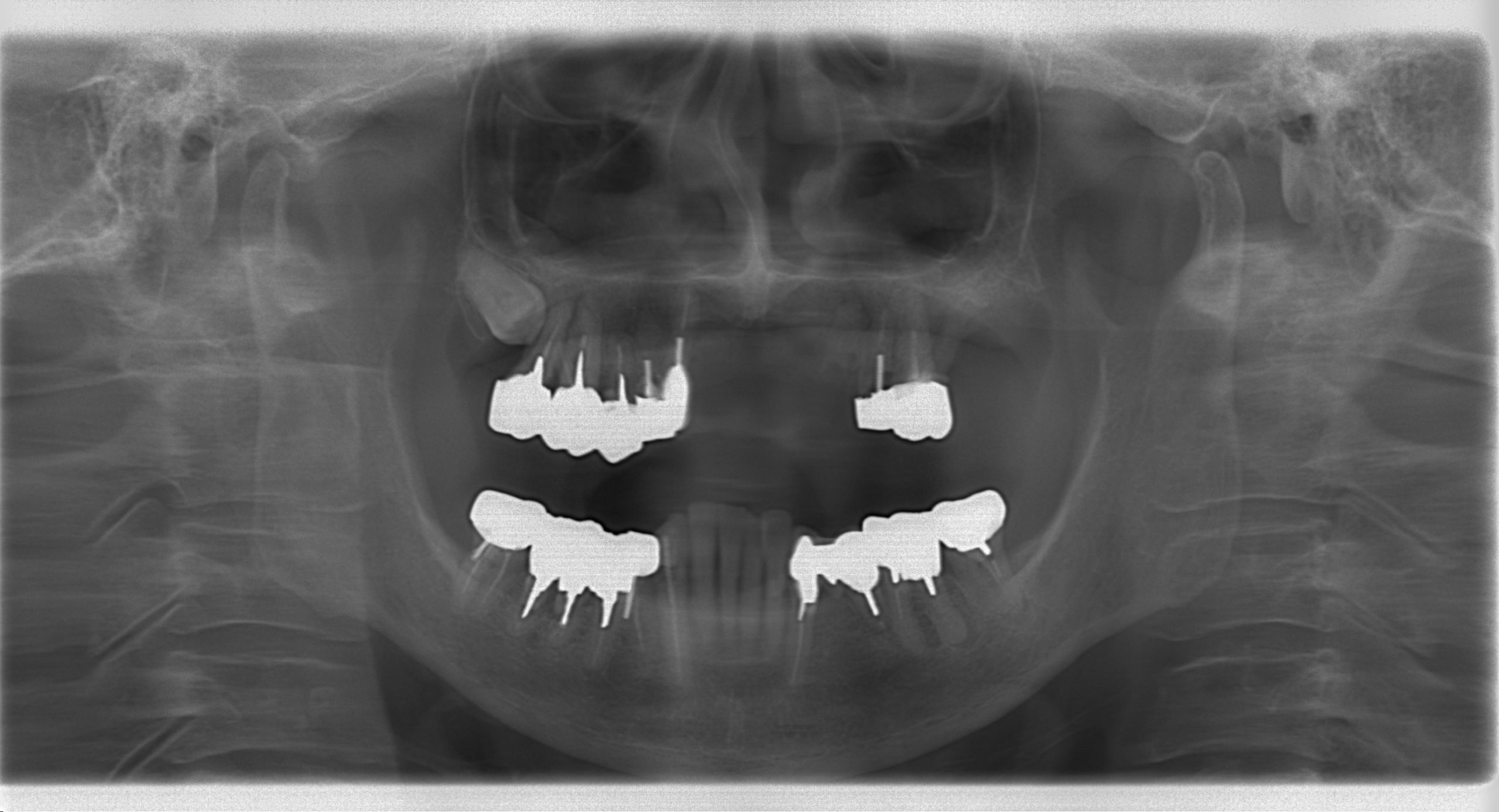 嘔吐反射が強く義歯が使えないためコーヌスデンチャーで治療した症例