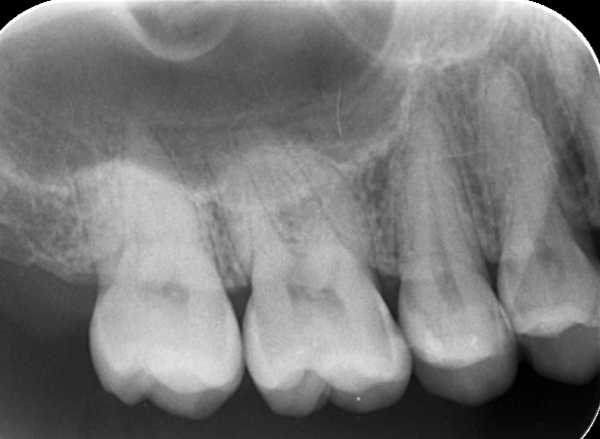 ダイレクトボンディングにより歯の間の虫歯を修復したケース