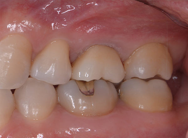 歯が原因の上顎洞炎を精密根管治療で治療したケース