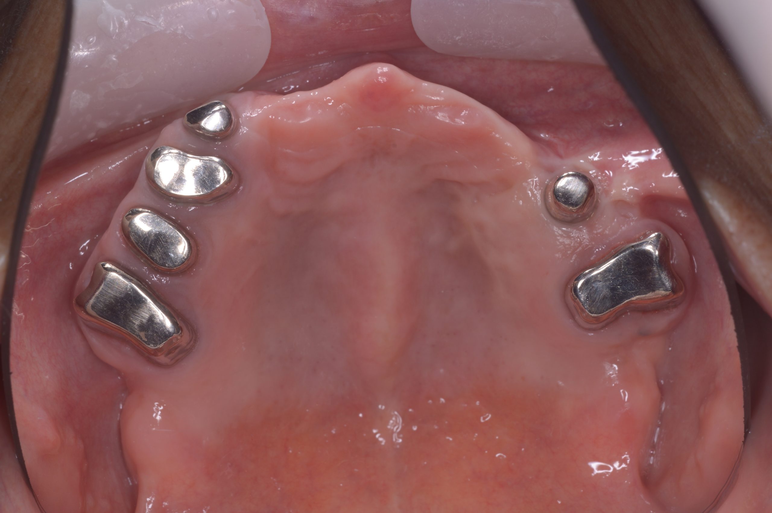 嘔吐反射が強く義歯が使えないためコーヌスデンチャーで治療した症例