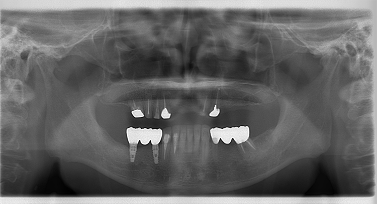 咬める入れ歯とインプラントでかみ合わせ治療した例