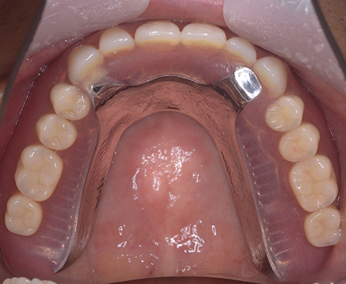 咬める入れ歯とインプラントでかみ合わせ治療した例