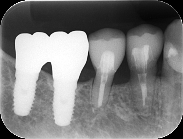 虫歯でボロボロの歯を歯周治療で保存したケース