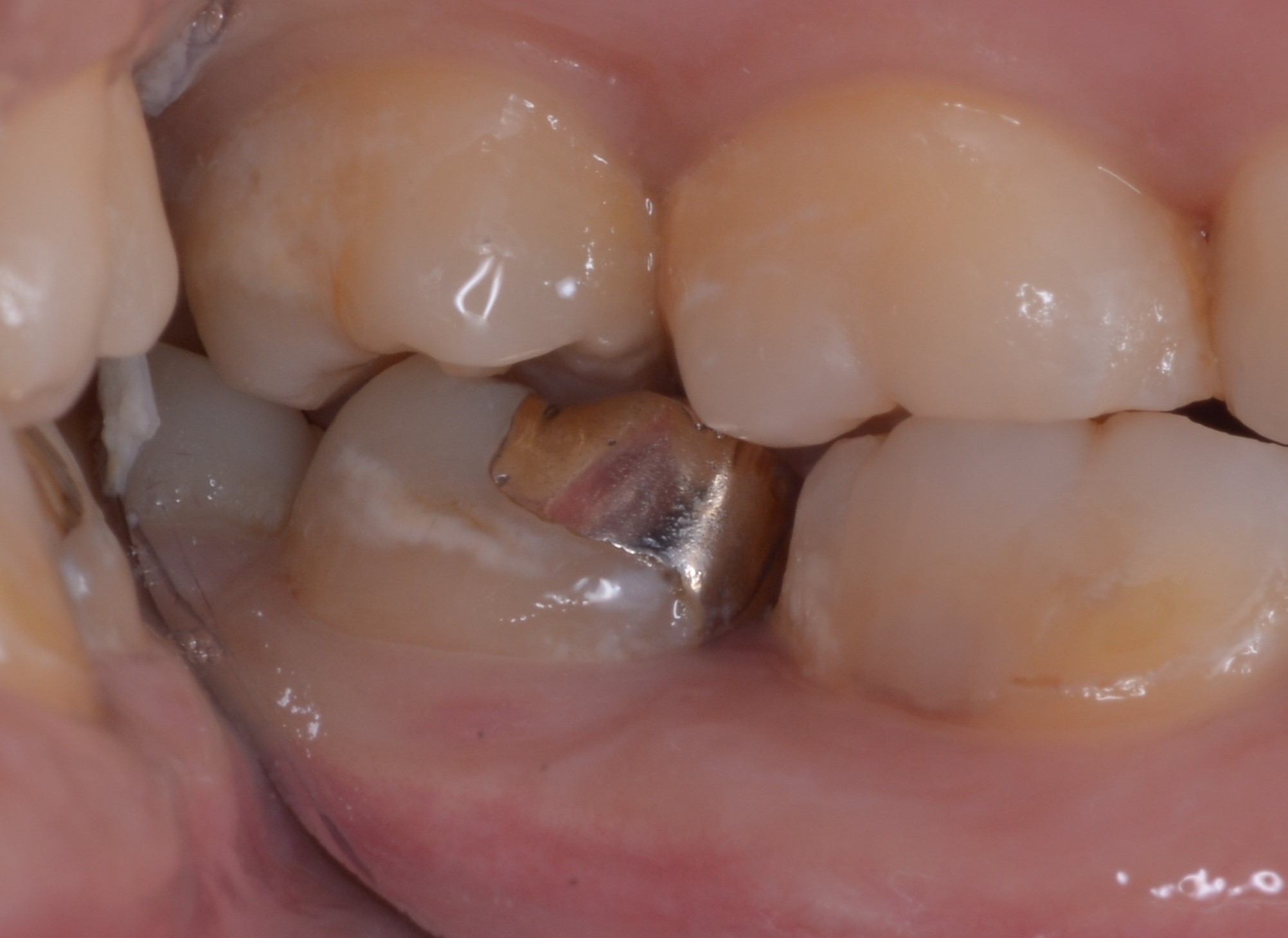 虫歯で神経が死んでしまった歯を保存するための治療