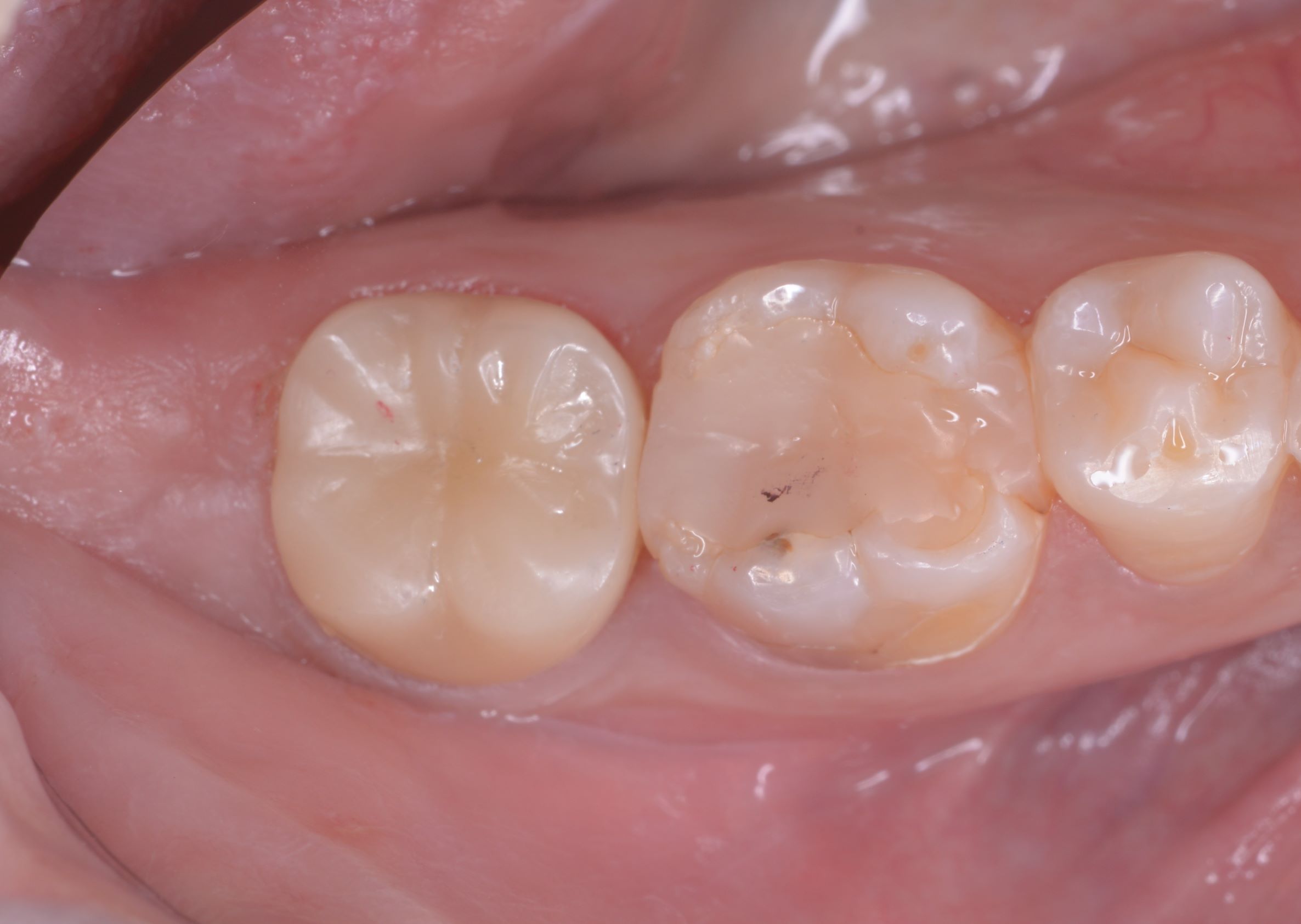 虫歯で神経が死んでしまった歯を保存するための治療後