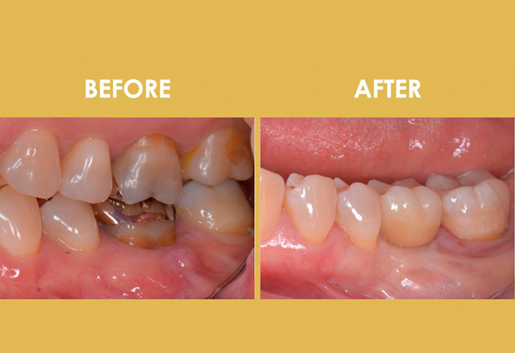 50代女性 重度の歯周病だった奥歯をインプラントと歯周再生療法で治療